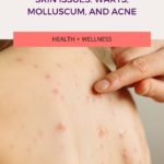 Skin Issues Warts, Molluscum, and Acne Pin