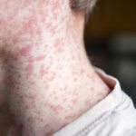 Measles Outbreaks Featured Image