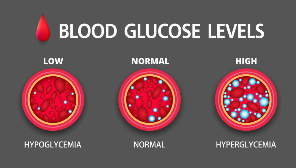 Hyperglycemia, High Blood Sugar and Diabetes 